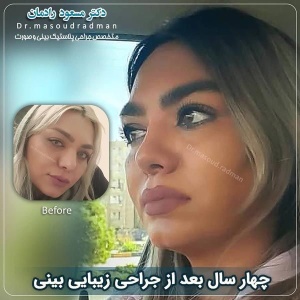 جراحی-بینی-در-کرمان-257