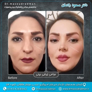 جراحی-بینی-در-کرمان-278