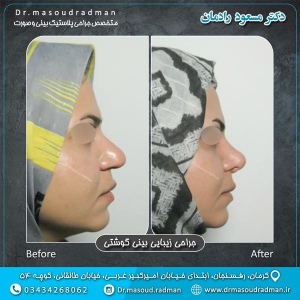 جراحی-بینی-در-کرمان-291