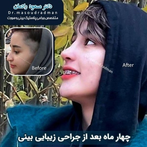جراحی-بینی-در-کرمان-293