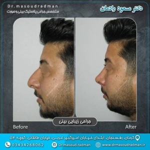 جراحی-بینی-در-کرمان-304
