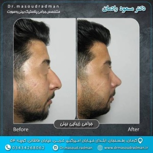 جراحی-بینی-در-کرمان-305