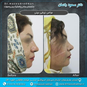 جراحی-بینی-در-کرمان-31