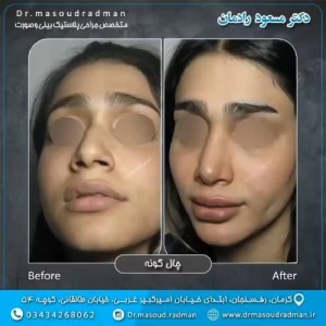 جراحی-بینی-در-کرمان-311