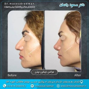 جراحی-بینی-در-کرمان-315
