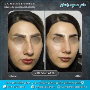 جراحی-بینی-در-کرمان-320