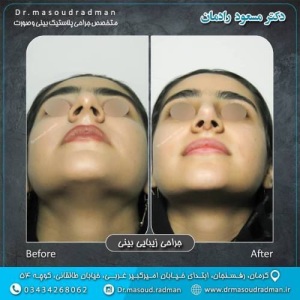 جراحی-بینی-در-کرمان-322
