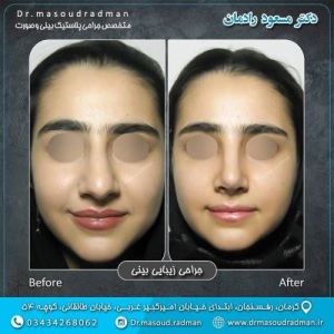 جراحی-بینی-در-کرمان-323