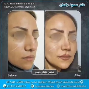 جراحی-بینی-در-کرمان-328