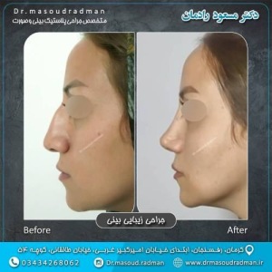 جراحی-بینی-در-کرمان-329