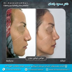 جراحی-بینی-در-کرمان-330
