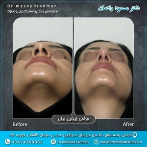 جراحی-بینی-در-کرمان-331