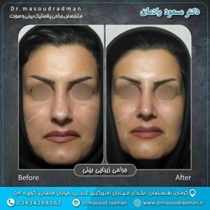 جراحی-بینی-در-کرمان-332