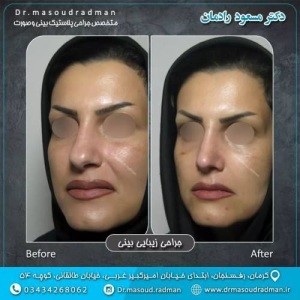 جراحی-بینی-در-کرمان-333