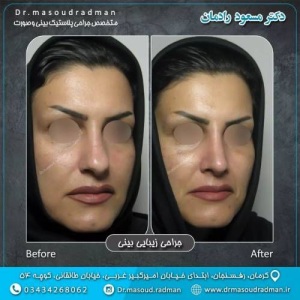 جراحی-بینی-در-کرمان-334