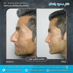 جراحی-بینی-در-کرمان-335