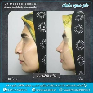 جراحی-بینی-در-کرمان-341