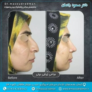 جراحی-بینی-در-کرمان-342