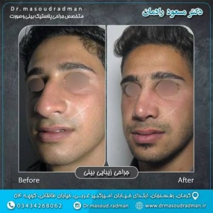 جراحی-بینی-در-کرمان-343