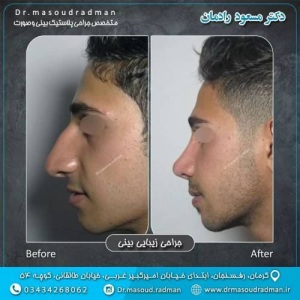 جراحی-بینی-در-کرمان-345