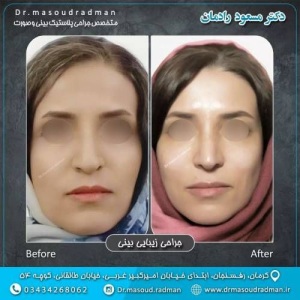 جراحی-بینی-در-کرمان-347