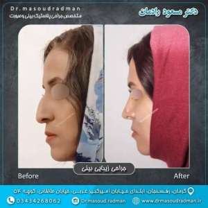 جراحی-بینی-در-کرمان-349