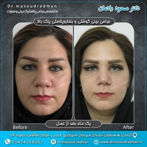 جراحی-بینی-در-کرمان-35