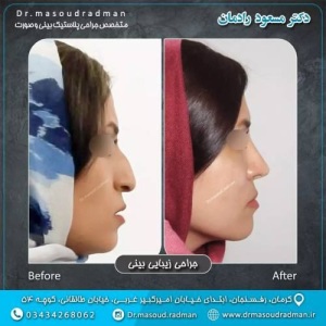 جراحی-بینی-در-کرمان-350