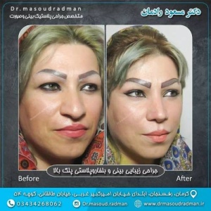 جراحی-بینی-در-کرمان-355