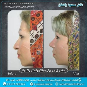 جراحی-بینی-در-کرمان-356