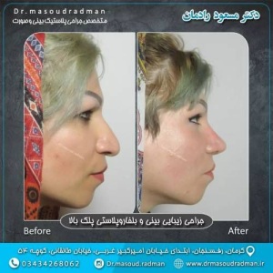 جراحی-بینی-در-کرمان-357