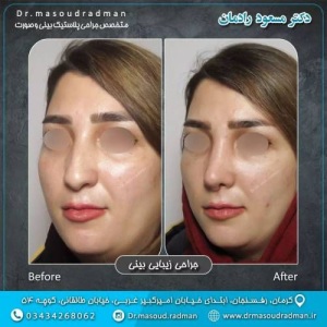 جراحی-بینی-در-کرمان-360
