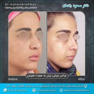 جراحی-بینی-در-کرمان-369