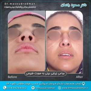جراحی-بینی-در-کرمان-370