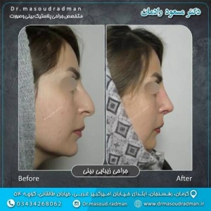 جراحی-بینی-در-کرمان-377