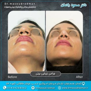 جراحی-بینی-در-کرمان-392