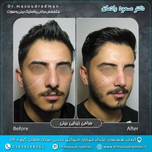 جراحی-بینی-در-کرمان-399