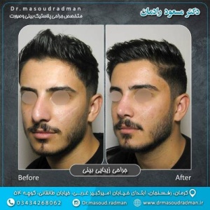 جراحی-بینی-در-کرمان-400
