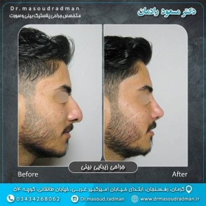 جراحی-بینی-در-کرمان-401