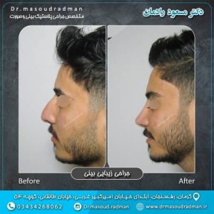 جراحی-بینی-در-کرمان-402