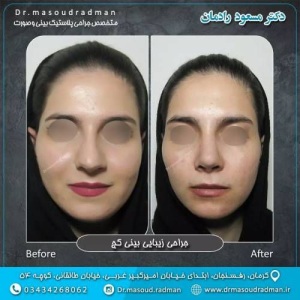 جراحی-بینی-در-کرمان-403