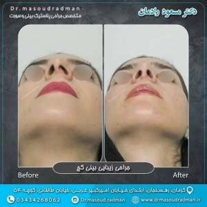 جراحی-بینی-در-کرمان-404