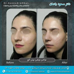 جراحی-بینی-در-کرمان-405