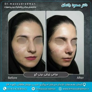 جراحی-بینی-در-کرمان-406