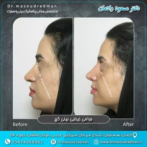 جراحی-بینی-در-کرمان-408