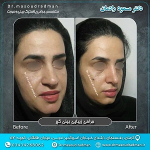 جراحی-بینی-در-کرمان-409