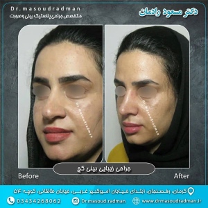 جراحی-بینی-در-کرمان-410