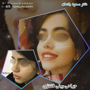جراحی-بینی-در-کرمان-457