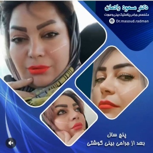 جراحی-بینی-در-کرمان-458