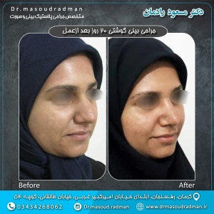 جراحی-بینی-در-کرمان-50